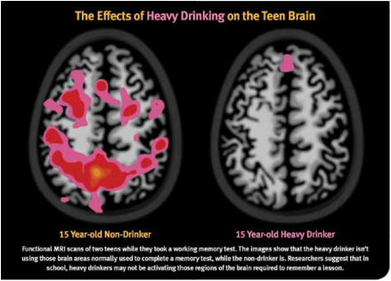 Alcohol And The Teen Brain 51